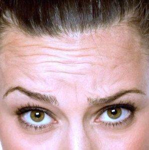 Forehead Wrinkles drderme 1
