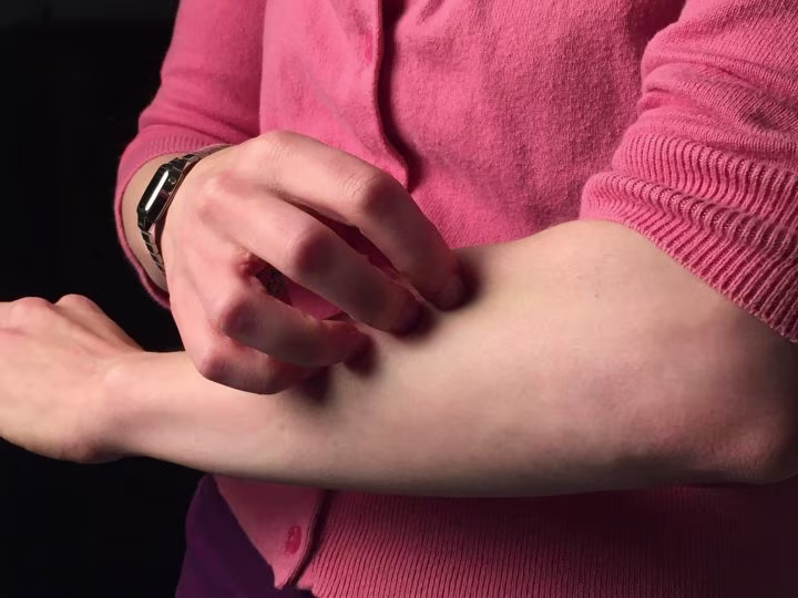 Blood Test For Itching
